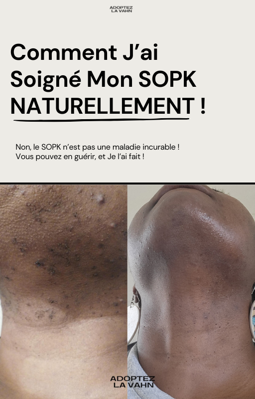 Pré-Vente : Comment J'ai Soigné Mon SOPK NATURELLEMENT !